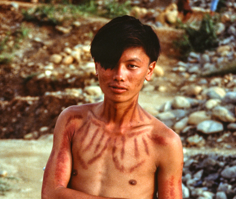 Bug spray Malaria is a major concern for anyone living or traveling in the jade-mines area. In this land of animism, the preferred local solution is embossing the skin by pinching it with a coin. The Maw-sisa miner at left is prepared for any kind of flying pest, as was Richard Hughes after he had the treatment applied. The efficacy of this bug protection was made crystal clear in Mogaung, where Hughes and Galibert slept side-by-side in the same bed. Come morning, Galibert's body was covered with bedbug bites, while Hughes was untouched.